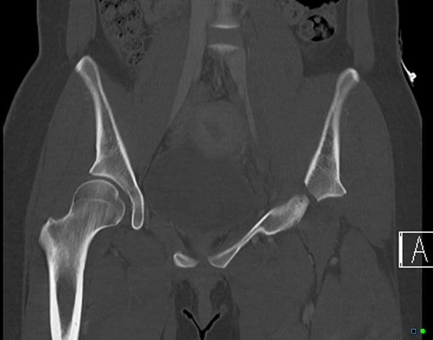File:Bilateral acetabular fractures (Radiopaedia 79272-92308 Coronal bone window 15).jpg
