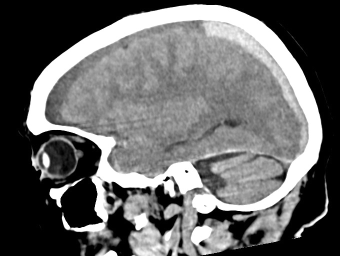 Bilateral acute on chronic subdural hematomas (Radiopaedia 78466-91146 C 21).jpg