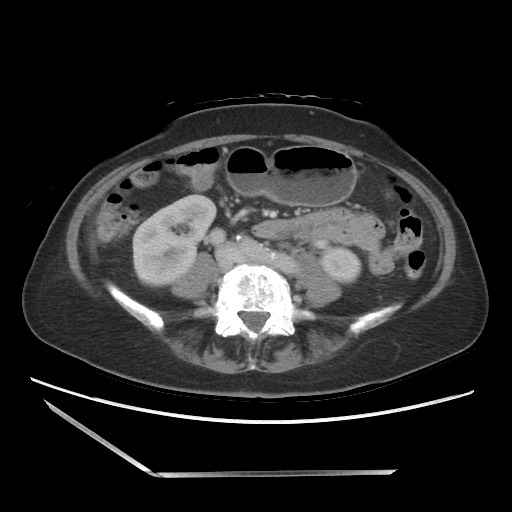 Bilateral adrenal granulocytic sarcomas (chloromas) (Radiopaedia 78375-91007 A 70).jpg