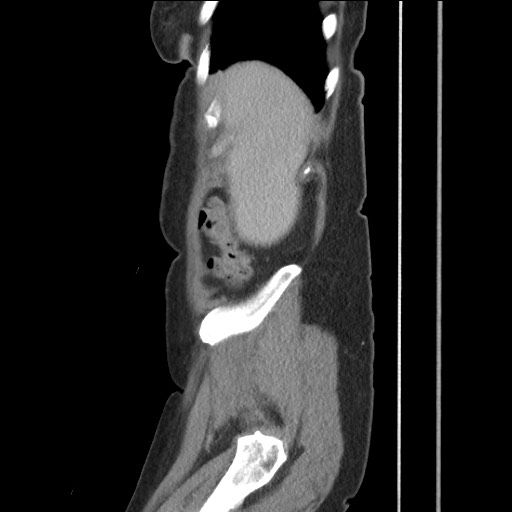 Bilateral adrenal granulocytic sarcomas (chloromas) (Radiopaedia 78375-91007 C 29).jpg