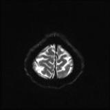 Bilateral basal ganglia and thalamic T1 hyperintensities (Radiopaedia 19764-19802 Axial DWI 19).jpg