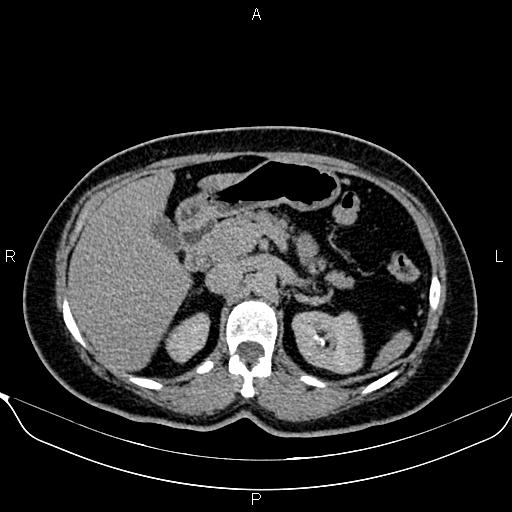 Bilateral benign adrenal adenomas (Radiopaedia 86912-103124 Axial C+ delayed 40).jpg