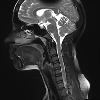 File:Bilateral carotid body tumors and right jugular paraganglioma (Radiopaedia 20024-20060 Sagittal 27).jpg