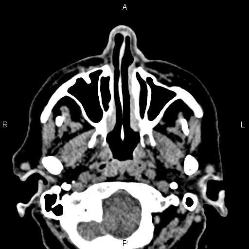File:Bilateral enlargement of lacrimal glands - sarcoidosis (Radiopaedia 62627-70921 Axial non-contrast 7).jpg