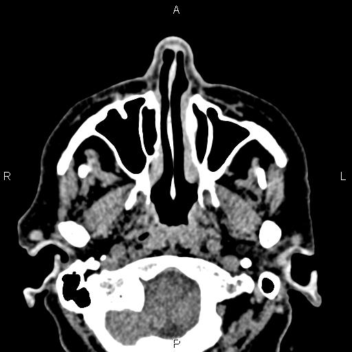 Bilateral enlargement of lacrimal glands - sarcoidosis (Radiopaedia 62627-70921 Axial non-contrast 8).jpg