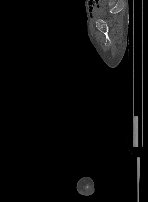 Bilateral fibular hemimelia type II (Radiopaedia 69581-79491 Sagittal bone window 37).jpg