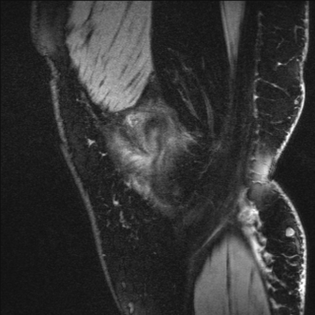 Bilateral focal pigmented villonodular synovitis (Radiopaedia 67643-77073 Sagittal T1 vibe 57).jpg