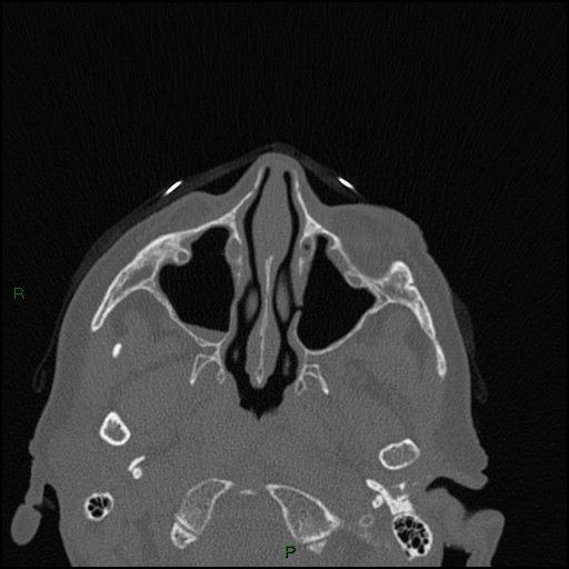 File:Bilateral frontal mucoceles (Radiopaedia 82352-96454 Axial bone window 187).jpg