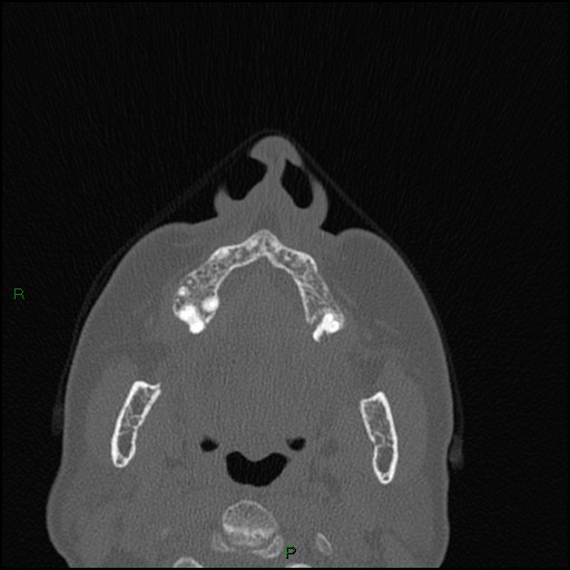 Bilateral frontal mucoceles (Radiopaedia 82352-96454 Axial bone window 250).jpg