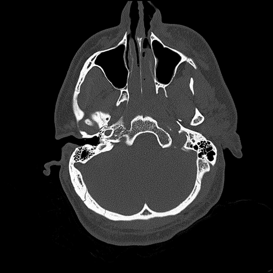 Bilateral occipital condyle fracture (type 2) (Radiopaedia 87675-104089 Axial bone thins 46).jpg