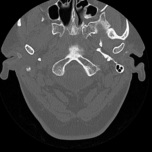 File:Bilateral ossifications of the external auditory canal (Radiopaedia 15233-15076 Axial bone window 25).jpg