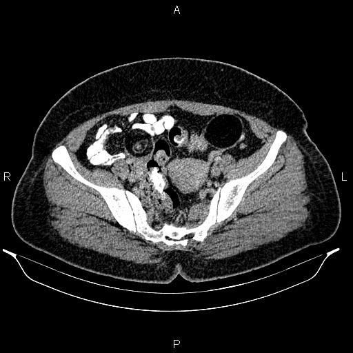 File:Bilateral ovarian dermoid cysts (Radiopaedia 85785-101603 A 86).jpg