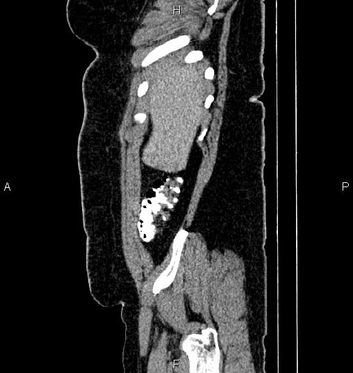 File:Bilateral ovarian dermoid cysts (Radiopaedia 85785-101603 D 4).jpg