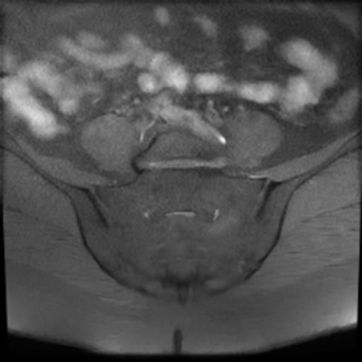 File:Bilateral ovarian dermoid cysts (Radiopaedia 90152-107338 Axial T1 fat sat 2).jpg