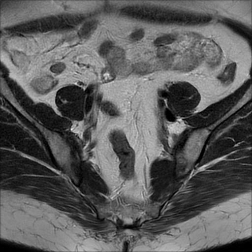 File:Bilateral ovarian dermoid cysts (Radiopaedia 90152-107338 Axial T2 6).jpg