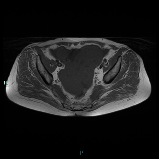 File:Bilateral ovarian fibroma (Radiopaedia 44568-48293 Axial T1 13).jpg