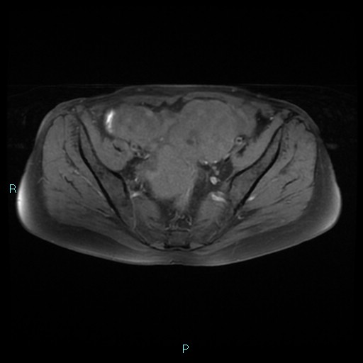 File:Bilateral ovarian fibroma (Radiopaedia 44568-48293 Axial T1 fat sat 11).jpg