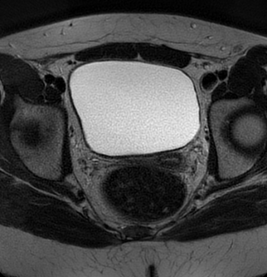 File:Bilateral ovarian fibrothecomas - adolescent (Radiopaedia 86604-102707 Axial T2 30).jpg