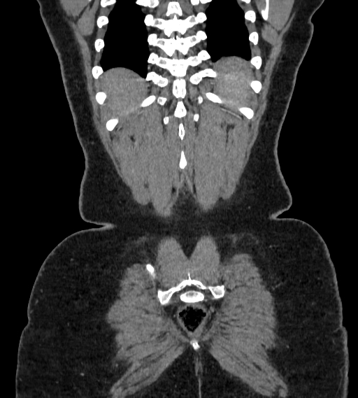 Bilateral ovarian mature cystic teratomas (Radiopaedia 79373-92457 B 102).jpg