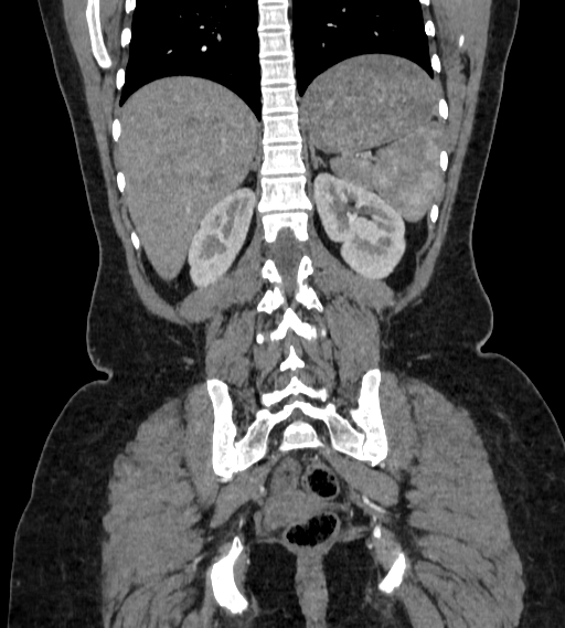File:Bilateral ovarian mature cystic teratomas (Radiopaedia 79373-92457 B 72).jpg