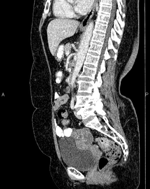 Bilateral ovarian serous cystadenocarcinoma (Radiopaedia 86062-101989 E 45).jpg