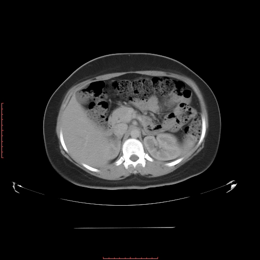 File:Bilateral ovarian serous cystadenocarcinoma with right ovarian torsion (Radiopaedia 32640-33611 A 13).jpg