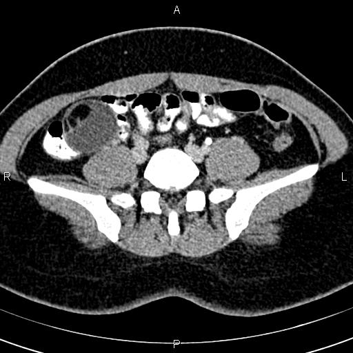 Bilateral ovarian teratoma (Radiopaedia 83131-97503 B 11).jpg
