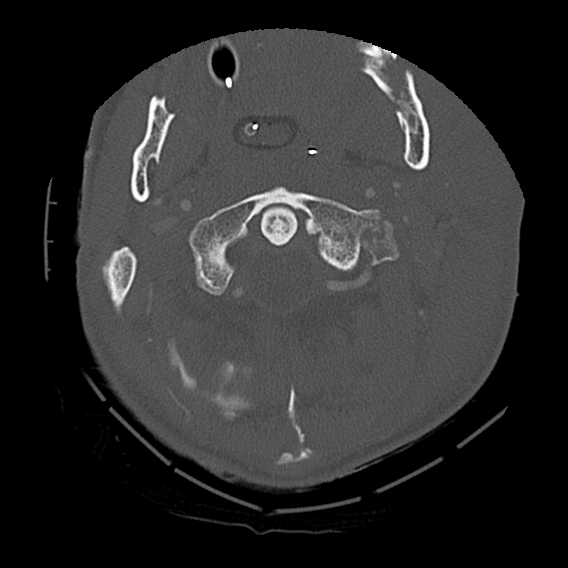 File:Bilateral perched facets with cord injury (Radiopaedia 45587-49713 Axial bone window 26).jpg