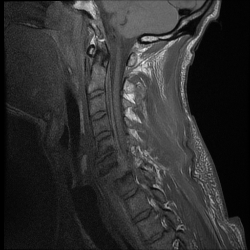 File:Bilateral perched facets with cord injury (Radiopaedia 45587-49714 Sagittal T1 10).jpg