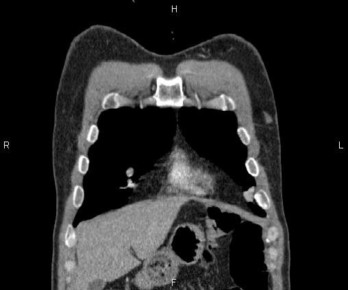 File:Bilateral pulmonary AVM (Radiopaedia 83134-97505 C 14).jpg
