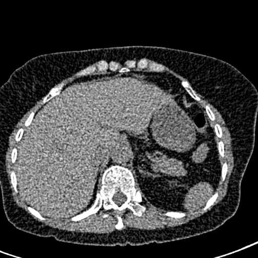 Bilateral staghorn calculi (Radiopaedia 59475-66842 Axial non-contrast 3).jpg