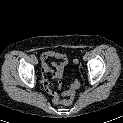 Bilateral staghorn calculi (Radiopaedia 59475-66842 Axial non-contrast 75).jpg