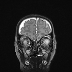 File:Bilateral subdural hemorrhage and parietal skull fracture (Radiopaedia 26058-26190 Coronal T2 3).png