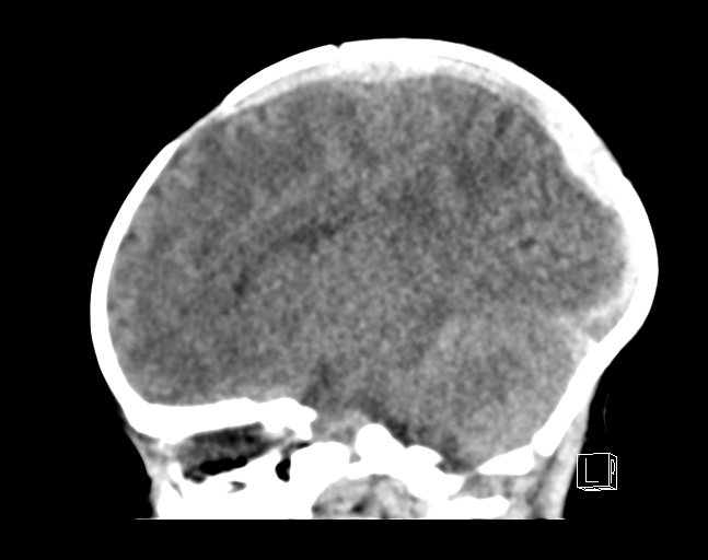 File:Bilateral subdural hemorrhage and parietal skull fracture (Radiopaedia 26058-26192 C 14).png