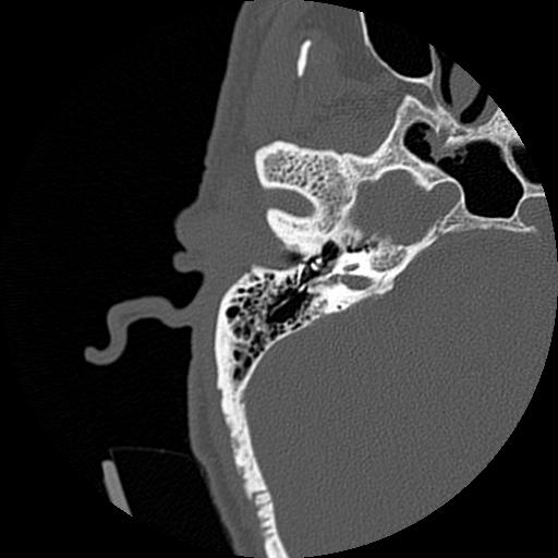 File:Bilateral temporal bone fractures (Radiopaedia 29482-29970 Axial non-contrast 28).jpg