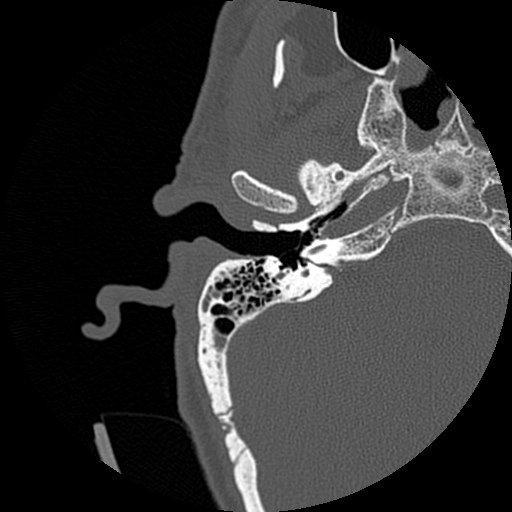 File:Bilateral temporal bone fractures (Radiopaedia 29482-29970 Axial non-contrast 8).jpg