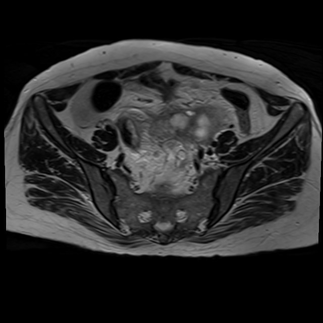 Bilateral tubo-ovarian abscesses (Radiopaedia 58635-65829 Axial T2 12).jpg