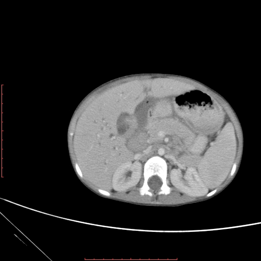 Biliary tract embryonal rhabdomyosarcoma (Radiopaedia 51815-57648 A 41).jpg