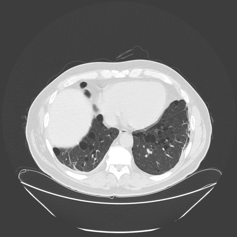 Birt-Hogg-Dubé syndrome (Radiopaedia 52578-58491 Axial lung window 45).jpg
