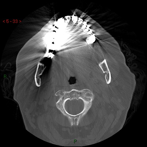 File:Bisphosphonate-related osteonecrosis of the jaw (Radiopaedia 54147-60329 Axial bone window 27).jpg