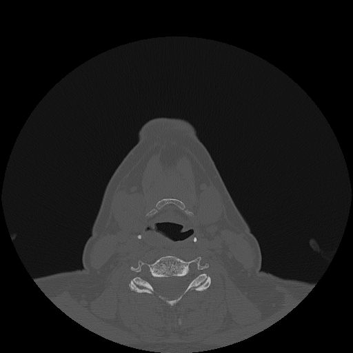 File:Bisphosphonate-related osteonecrosis of the jaw (Radiopaedia 71324-81642 Axial bone window 3).jpg