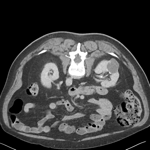 File:Bladder papillary urothelial carcinoma (Radiopaedia 48119-52951 Axial C+ delayed 19).png