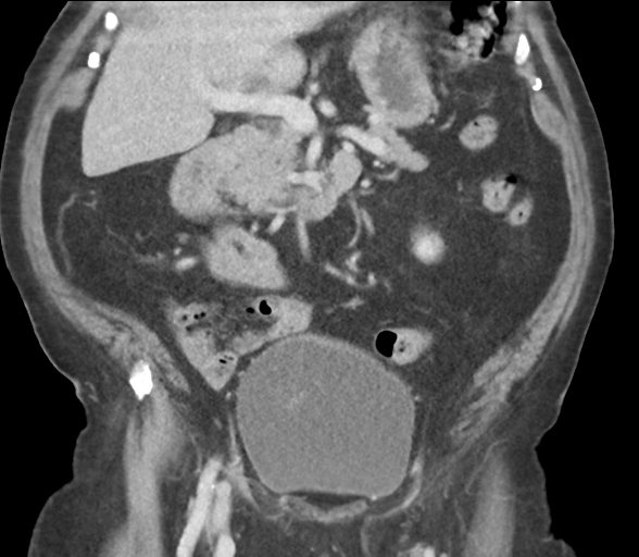Bladder papillary urothelial carcinoma (Radiopaedia 48119-52951 C 32).png
