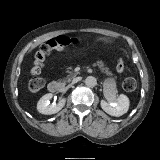 Bladder tumor detected on trauma CT (Radiopaedia 51809-57609 C 52).jpg