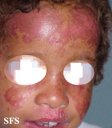 Bloom Syndrome (Dermatology Atlas 3).jpg