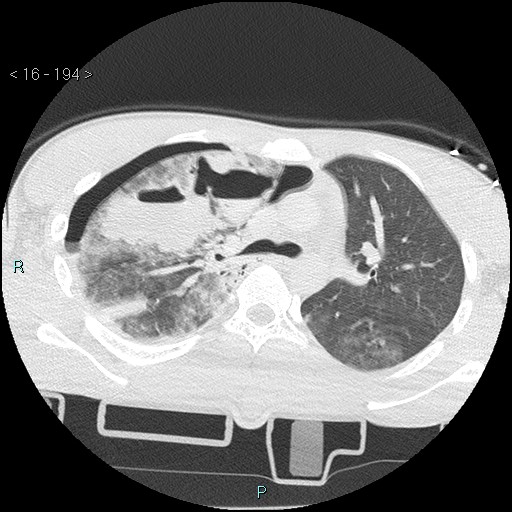 Blunt chest trauma (Swiss cheese sign) (Radiopaedia 38519-40618 Axial lung window 25).jpg