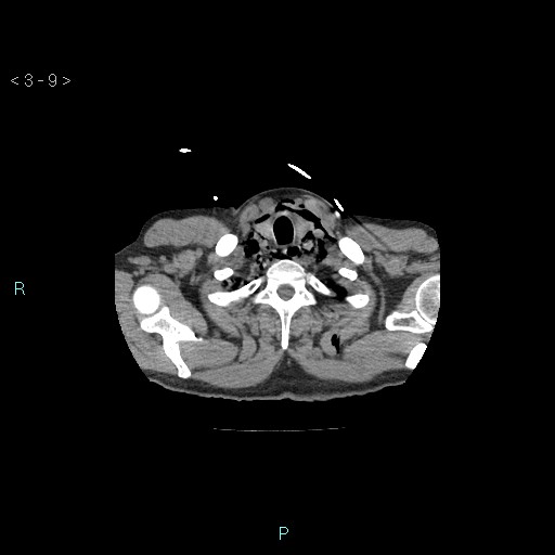 File:Boerhaave syndrome (Radiopaedia 27683-27897 Axial non-contrast 9).jpg
