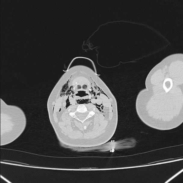 Boerhaave syndrome (Radiopaedia 45644-49799 Axial lung window 3).jpg