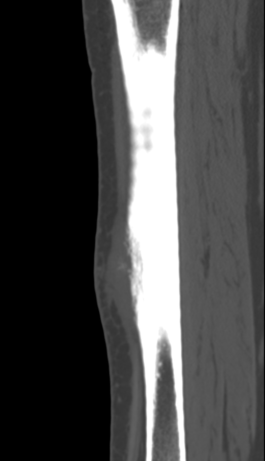 Bone metastasis - tibia (Radiopaedia 57665-64609 Sagittal bone window 102).jpg