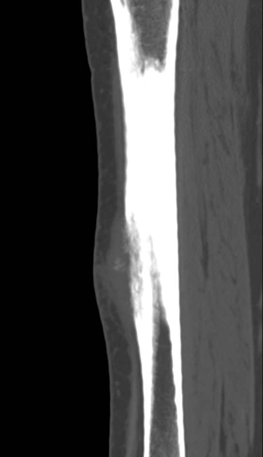 Bone metastasis - tibia (Radiopaedia 57665-64609 Sagittal bone window 98).jpg